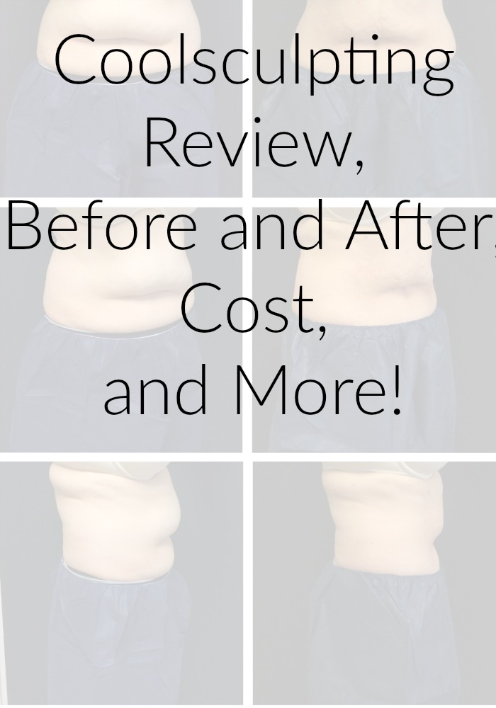Coolsculpting Review, Before and After, Cost, and More!