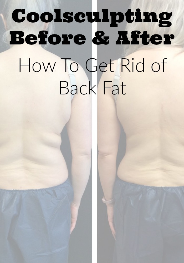 Coolsculpting Before and After | How To Get Rid of Upper Back Fat